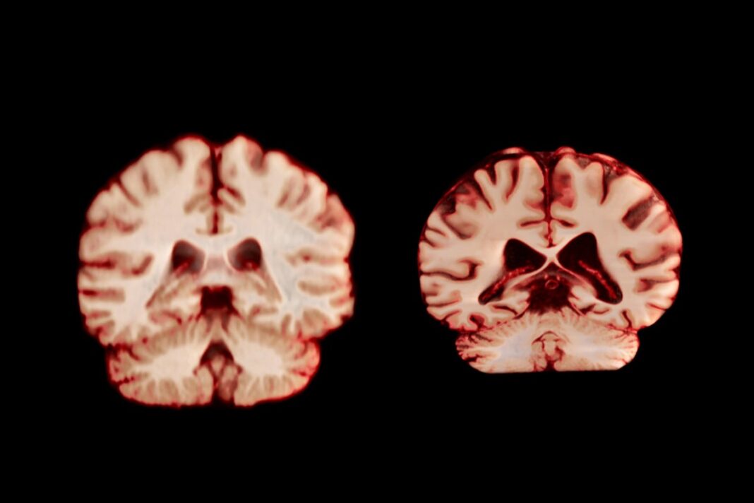 Men’s Brains Shrink Faster than Women’s. What That Means for Alzheimer’s