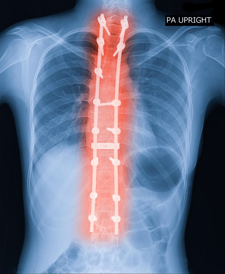 New Groundbreaking Scoliosis Study 8 Years In The Making: What To Know
